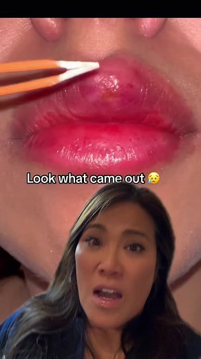 #duet with @Pcos_babe #Relatable i think this is a cold sore/ fever blister. Do not try to pop this.