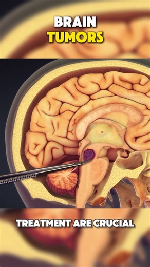 5K views · 51 reactions | What Happens in Brain Tumor Symptoms, Causes and Treatment (3D Animation) #braintumor #craniotomy #brainsurgery #craniectomysurgery #braintumorsurgery #braintumorsurvivor #braincancer #braincancertreatment #medical3danimation #3dmedicalanimation | Surgery Page | Facebook