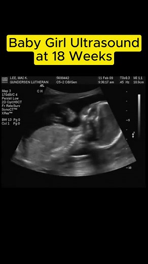 Baby Girl Ultrasound at 18 Weeks