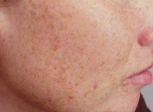 Liver Spots: Causes, Treatments, and Removal Options