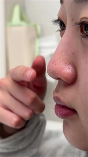 たった2週間でこの変化！？ 今話題の毛穴アンプルを試してみた！ ⁡ •毛穴の黒ずみ・開き・くすみを集中ケア •1日2回の簡単ケアでツルスベ肌に✨ •1ヶ月でワントーン明るい毛穴レス肌へ💖 ⁡ これからも継続して使ってみます🔥 ⁡ #BLANC #毛穴アンプル #韓国コスメ #スキンケア #美肌ケア