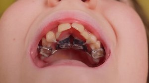 Orthodontic plate for align teeth. Dental palatal expander mechanism to straight teeth. Young child in clinic close up. Mouth, lips, tongue and unmovable plate. Healthcare and medicine