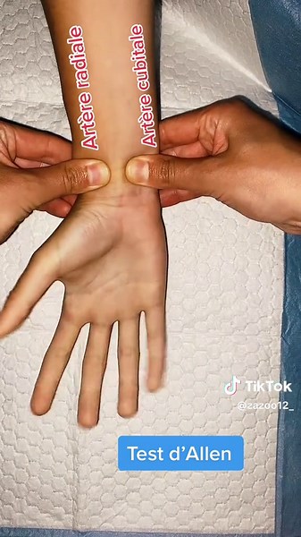 Test d’Allen : Vérifiez la circulation sanguine avant la ponction