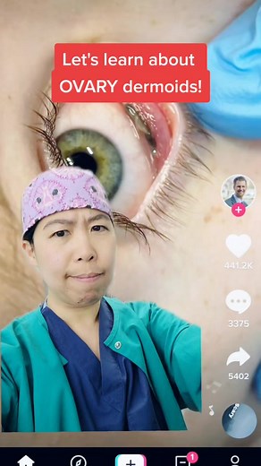 Hair and teeth in ovaries?! 😳 Yes, it's a real thing! #dermoidcyst #dermoidovariancyst