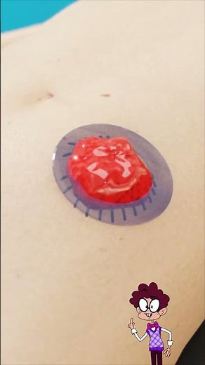 How a Colostomy Bag Actually Works