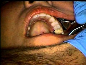 Physics Forceps #14 Endo Treated Tooth Extraction