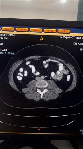 Acute Appendicitis with Fat Stranding on CT Abdomen #shorts