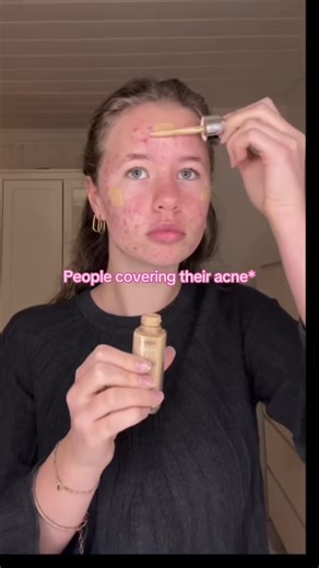 Embracing Acne: Beauty in Imperfection