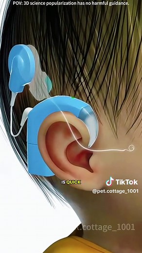 How Cochlear Implant Works? (3D Animation) #cochlearimplant #cochlearimplants #hearingloss #hearinglossprevention #hearinglossawareness #hearingaids #cochlearimplantsurgery #medical3danimation #3dmedicalanimation
