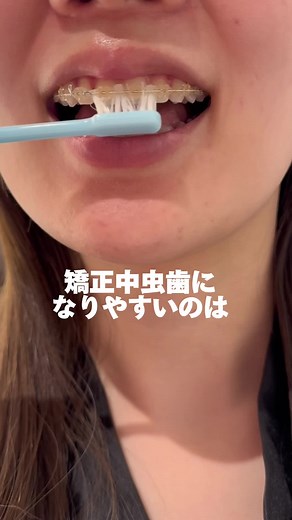 ワイヤー矯正中の歯ブラシケアの重要性