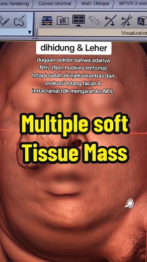 multiple soft tissue mass 40 y o #ctscan #radiologi #radiology #ge #scan #xray #mri #scanning #fyp #fypシ #fypシ゚viral #fypage #rontgen #ronsen #radiologist #radiologylife #radiologytechnologist #radiologytiktok #radiolog #MRI #RADIOLOGI #RONTGEN #CTSCAN #RADIASI #XRAY #TULANG #TUMOR #KANKER #PEMERIKSAAN #RADIOLOGIPEDIA #penyakit