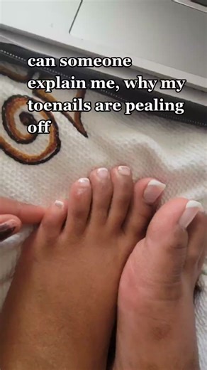Understanding Peeling Toenails: Causes and Solutions