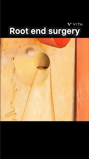 Apicoectomy #dentist #teeth