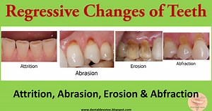 Regressive changes in Tooth : Attrition, Abrasion, Erosion and Abfraction