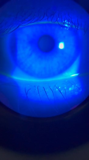 Eye Scratch Detection: Innovative Technology Revealed