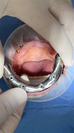 풀아치타입 전체임플란트 #dentist #dental #dentalprosthesis #implants #fullarch #fullarchimplants