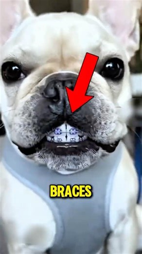 What Braces Really Do to Your Teeth It’s Not Just Pulling! 😱
