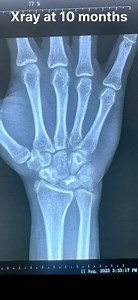 Perilunate Dislocation