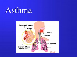 Asthma - SlideServe