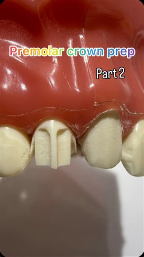 DR.DENTIQUE🦷 | 🔹 Premolar Crown Preparation – Part 2 1.Proximal Reduction • Break proximal contact carefully with thin tapered diamond. • Avoid... | Instagram