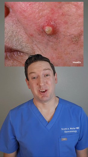 530K views · 4.1K reactions | What's on my skin: Squamous Cell Carcinoma #whatsonmyskin #whatsonmyface #skincancerawareness #scc #squamouscellcarcinoma #dermatologist #todayilearned #tiktokpartner #sunscreen #sunsafety #actinickeratosis | Scott Walter MD, FAAD | Facebook