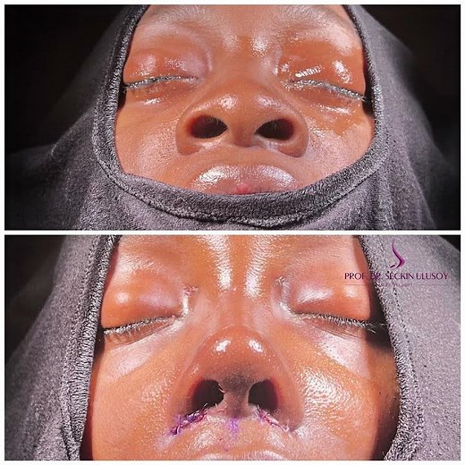 🌍 Ethnic Rhinoplasty Before & After | Natural Results in Istanbul, Turkey | Prof. Dr. Seçkin Ulusoy