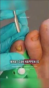 Why is this toenail so thick?