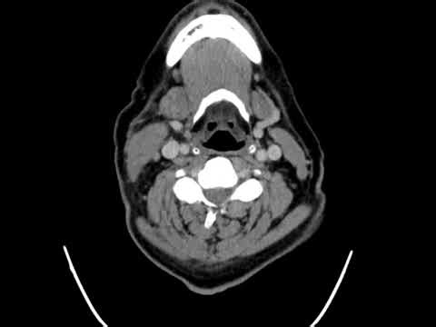 Emergency! Massive Neck Abscess ⚠️