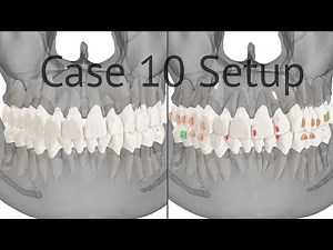 Maestro 3D aligners virtual setup: case 10, crowding, solved with upper jaw distalization and IPR