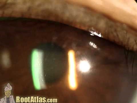 aqueous flare and cell