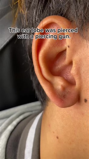 Troubleshooting Ear Piercing Issues: Expert Solutions