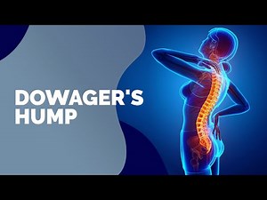 How to Deal with Dowager's Hump | Problem to Solution Session | MELT Method