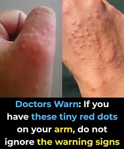 65K views · 25 reactions | Doctors warn: if you have these tiny red dots on your arm or hand, do not ignore the warning signs  | The Chronicle | Facebook