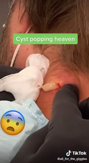 Explosive cyst pop. #pimplepop #cystpopping #blackheadremovals #whitehead #blackhead #pimpletiktok #oddlysatisfyingvideo #whiteheadremoval
