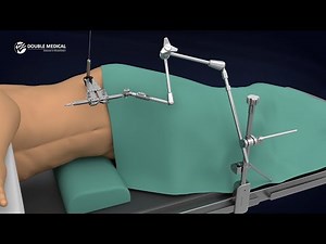 Revolutionize Spinal Surgery with MIS Anterolateral Spine Access System - Animated Guide