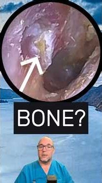 Exposed bone? Full video in link below