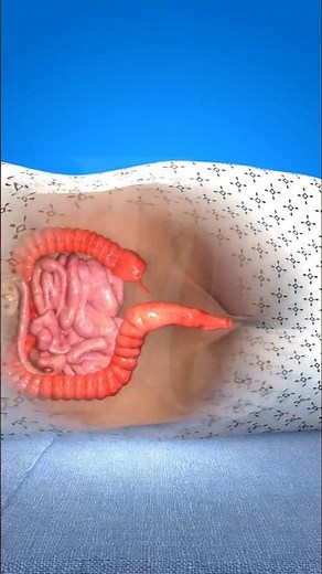 Colon Polypectomy: The Simple Procedure That Prevents Colon Cancer