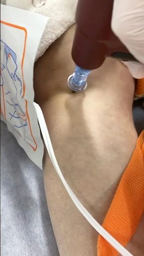 【循環器病棟 基本のキ】 #骨髄針穿刺 #骨髄穿刺 #IO #心肺蘇生 #動画 #よねしろICLS