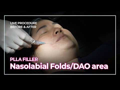 [Mitelier] PLLA Layering Technique