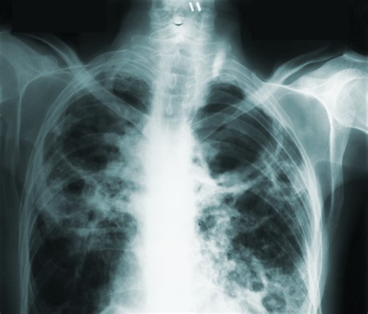 N.J. resident in isolation after testing positive for tuberculosis