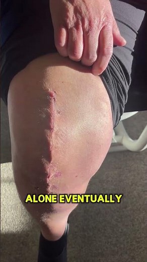 Knee Replacement Incision Assessment