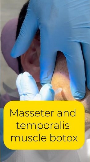 Masseter and temporalis muscle botox
