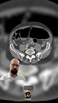 Understanding the closed-loop pattern and its complications in sigmoid volvulus