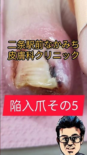 【陥入爪シリーズ】第5話 足の親指以外の肉芽腫は手術せずに治ることもある #陥入爪 #巻き爪 #皮膚科 #爪の痛み #フットケア #皮膚科 #深爪
