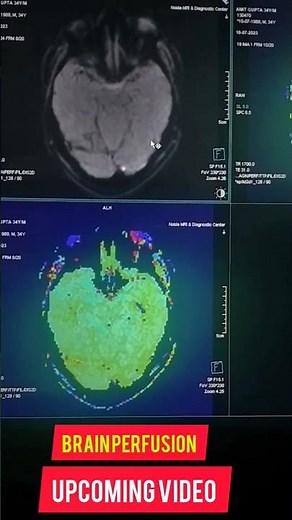 MRI BRAIN PERFUSION