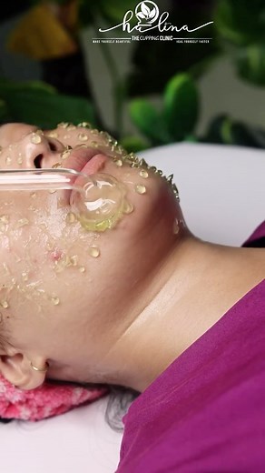 229K views · 1.3K reactions | Acne treatment . . . . . . . . . . ....