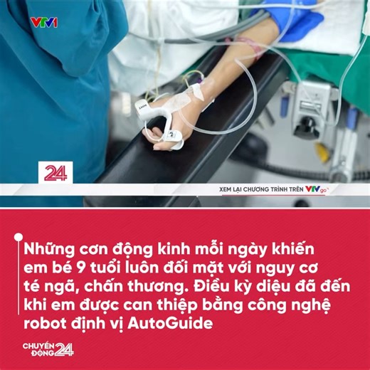 Lần đầu tiên tại Việt Nam, một ca phẫu thuật não sử dụng robot đặt điện cực nội sọ đo điện não đồ đã được thực hiện thành công, từ đó giúp xác định và loại bỏ được ổ động kinh cho một bé trai 9 tuổi mắc chứng động kinh kháng trị. Không chỉ là phép màu với riêng em, đây còn là dấu mốc quan trọng khi công nghệ cao mở ra cánh cửa mới cho những ca bệnh từng được xem là khó trước đây. #chuyendong24h | Chuyển động 24h