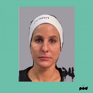 淋PDO threading completely re-defines facial contours and induces...