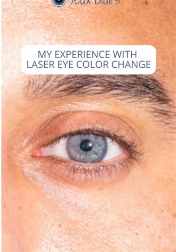 Transforming Eye Color: A Joyful Journey to Lighter Eyes