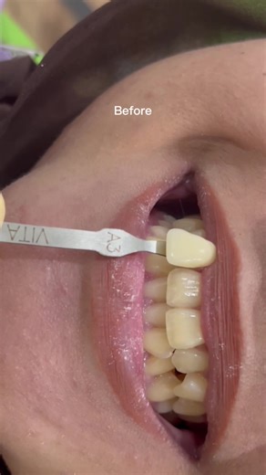 Hasil Whitening Gigi di Klinik Pergigian Raissa